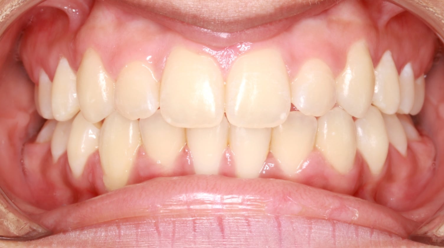 After 2-Phase Treatment