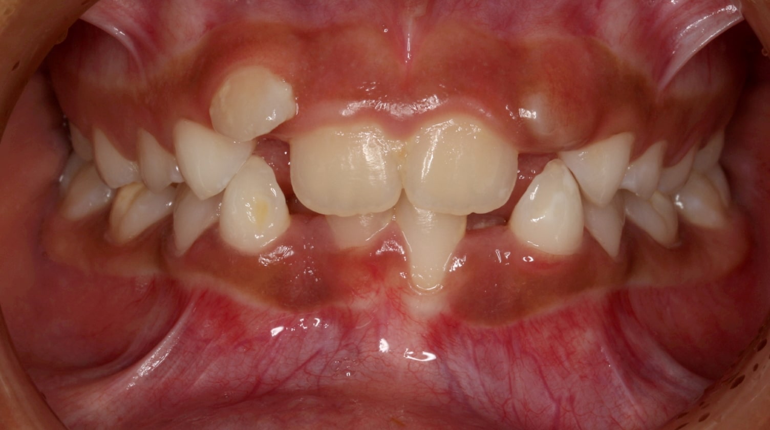 Before 2-Phase Treatment