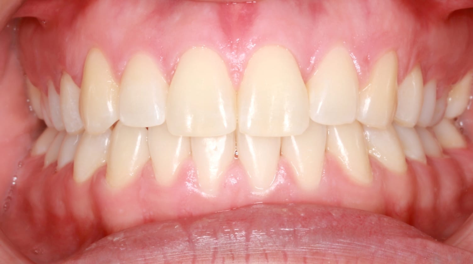 After Crossbite