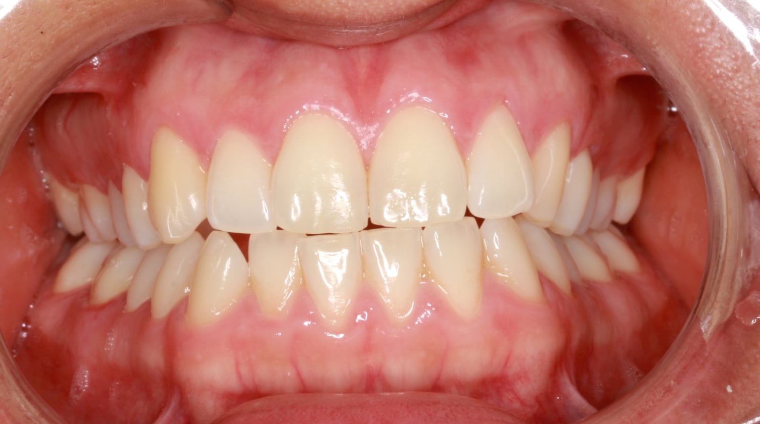 Before Crossbite