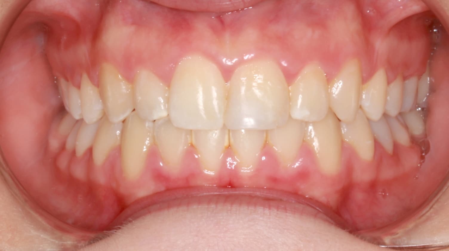 After Deep Bite