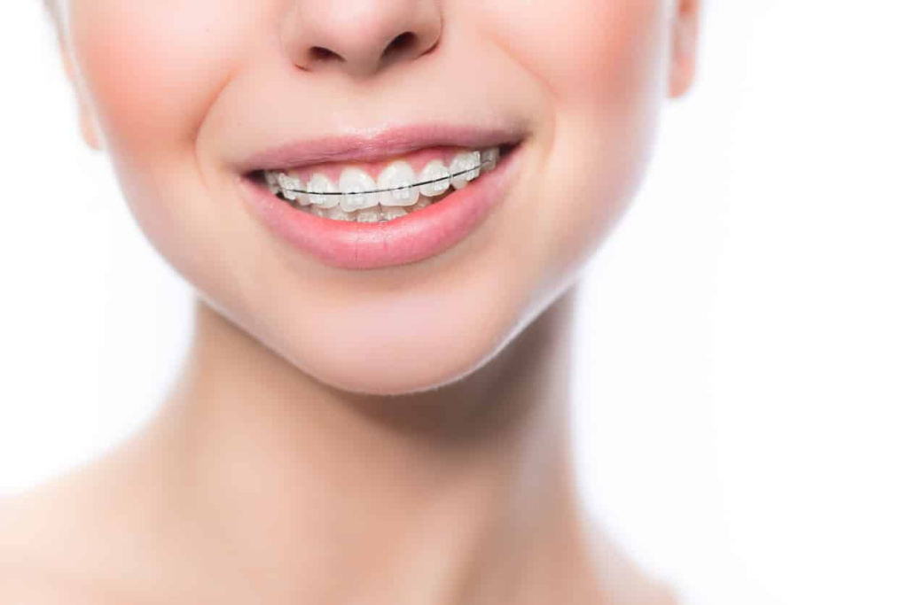 Ceramic braces