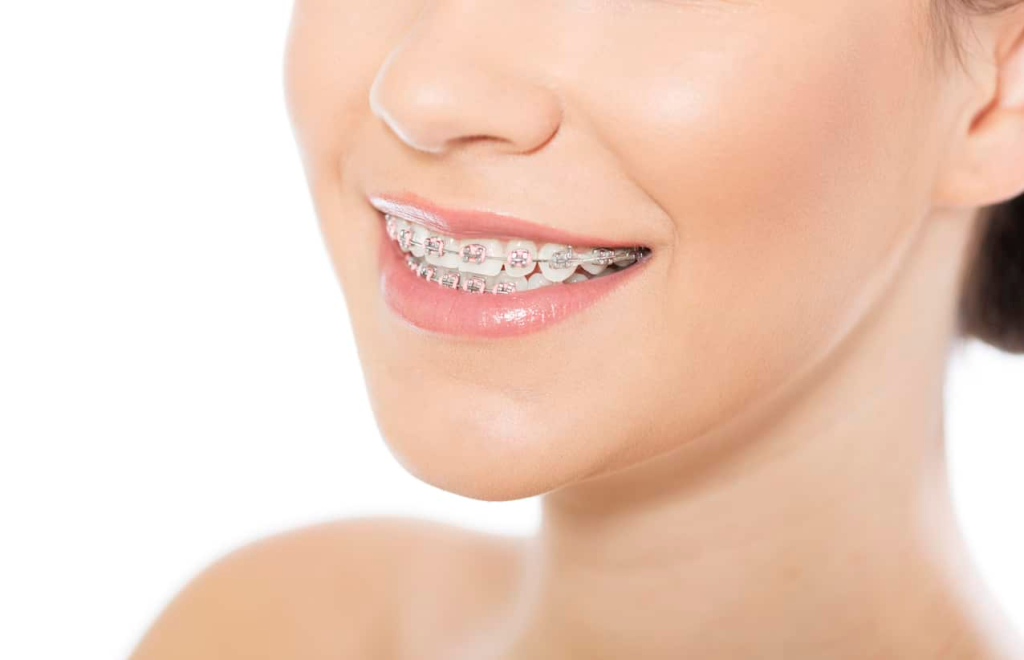 Traditional metal braces