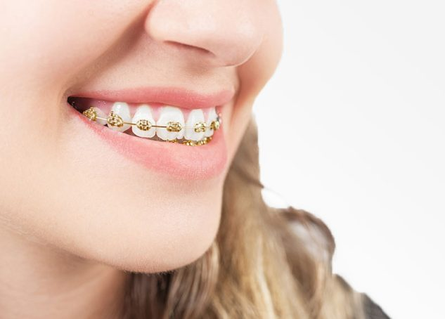 Gold braces